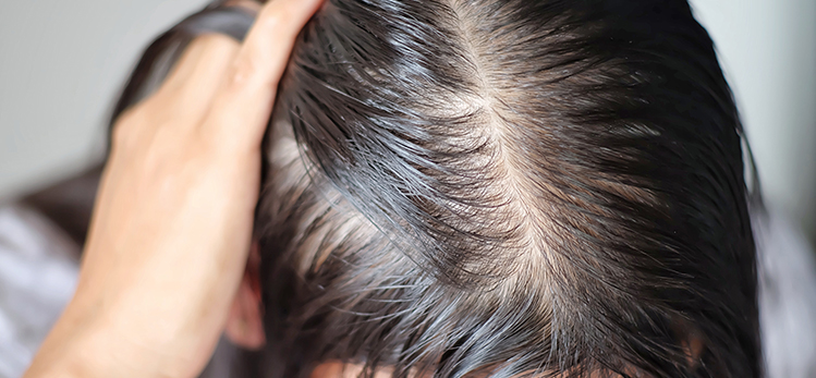 What reasons Thinning Hair?